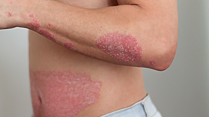 Psoriasis auf dem Arm und dem Bauch