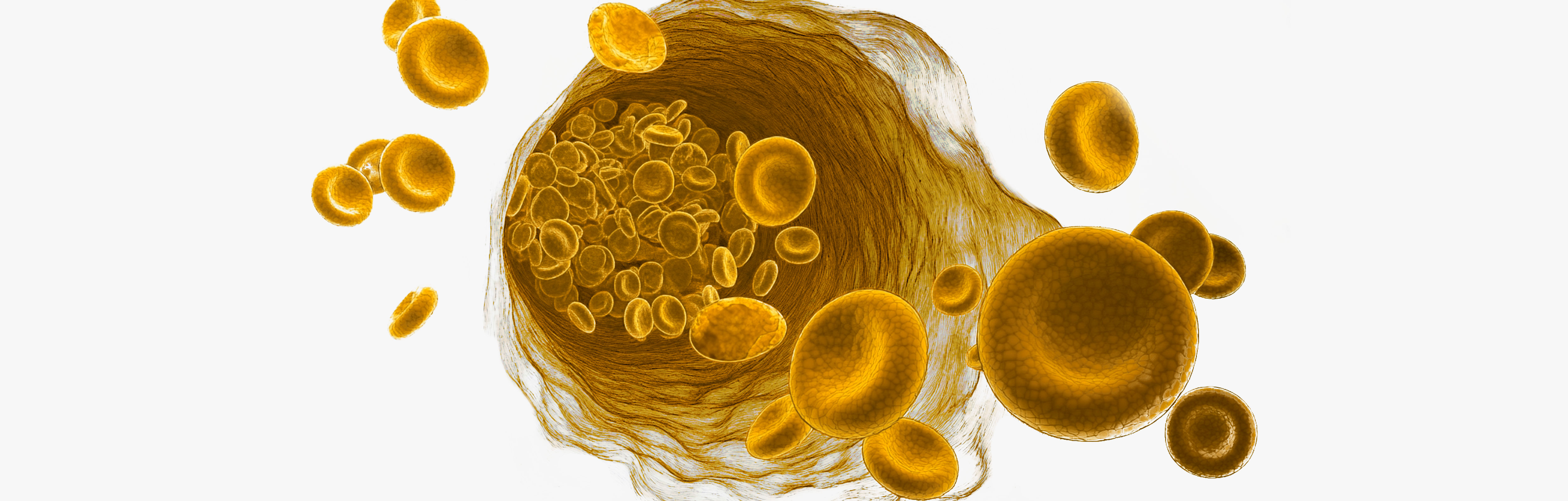 Excess iron in the blood
